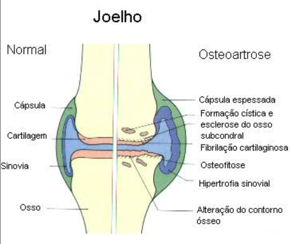 Joelho com Osteoartrite