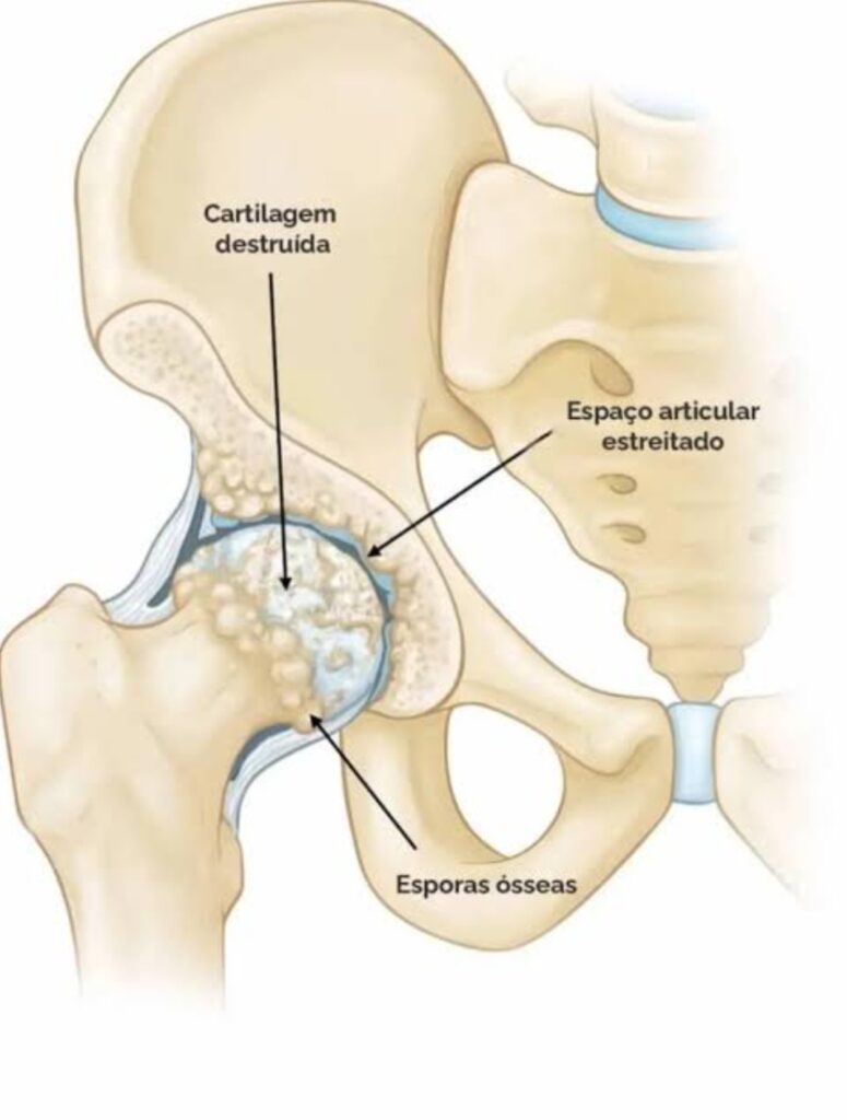 Articulação em processo de degeneração na Osteoartrite