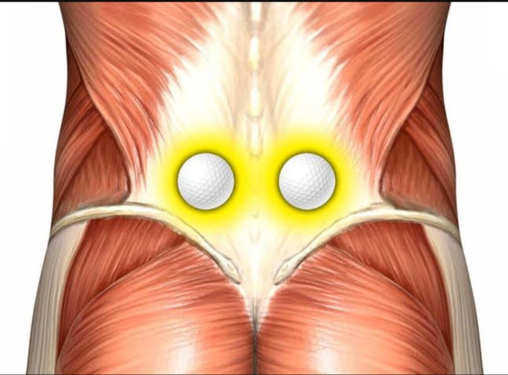 Lombalgia inespecífica - Síndrome Dolorosa Miofascial Lombar
