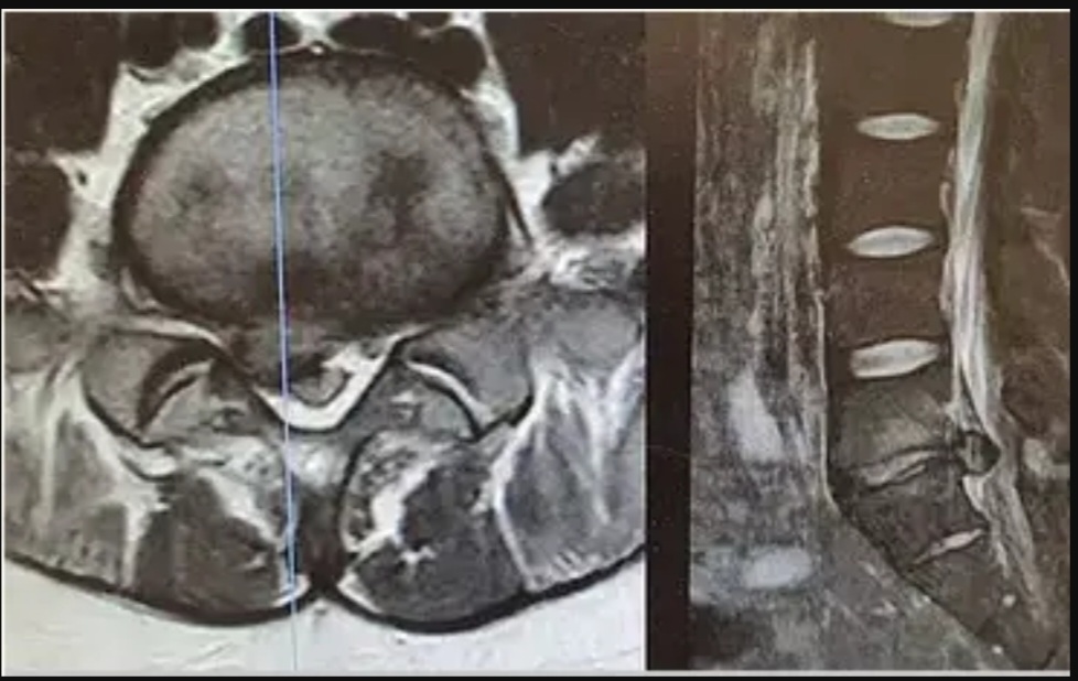 Hérnia Discal Lombar