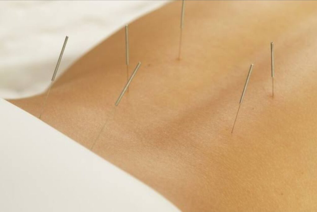 Agulhamento a seco: uma alternativa no tratamento da dor na coluna lombar